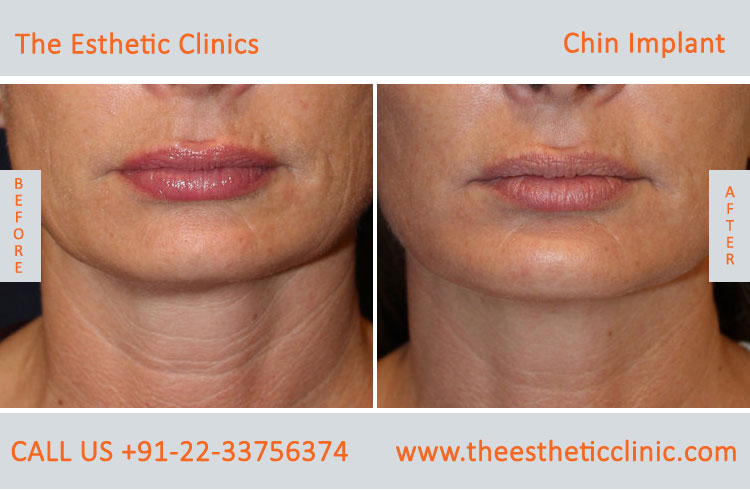 chin Augmentation, chin Implants surgery before after photos in mumbai india (5)